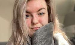 Psoriasis 