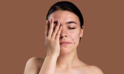 4 ways psoriasis can worsen if not managed well